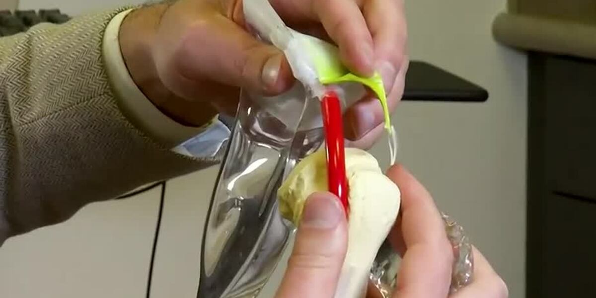 Baloon Spacwer YOUR HEALTH: Balloon spacers rescue rotator cuffs