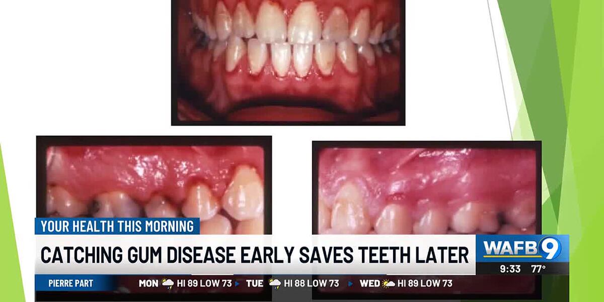Tooth Later YOUR HEALTH: Catching gum disease early saves teeth later